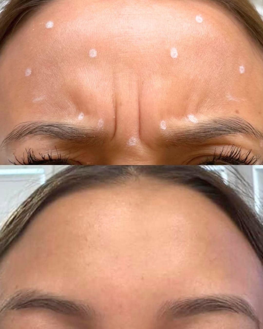 Anti-wrinkle injection treatment at Mastery of Aesthetics, Clophill Bedfordshire